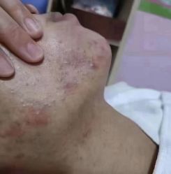 -瑶芳清颜草本祛痘