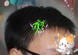 -大麦微针植发全国连锁