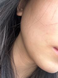 体验后-丰联丽格医疗美容·联合丽格眼整形中心