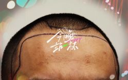 -大麦微针植发全国连锁