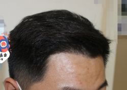 -大麦微针植发丨全国连锁