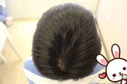 点击看大图 -大麦微针植发丨全国连锁