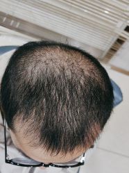 -大麦微针植发丨全国连锁
