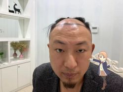 -大麦微针植发丨全国连锁