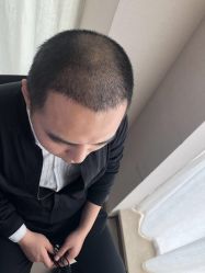 点击看大图 -大麦微针植发丨全国连锁