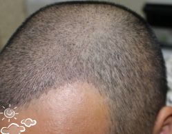 -大麦微针植发丨全国连锁