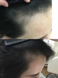 -菩叶脱发白发中心