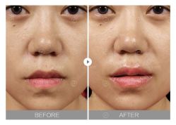 体验后-大华韩艺整形美容医院