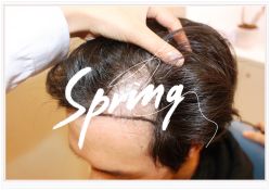 体验后-大麦微针植发全国连锁