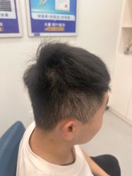 -大麦微针植发全国连锁