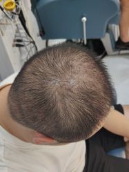 -大麦微针植发全国连锁