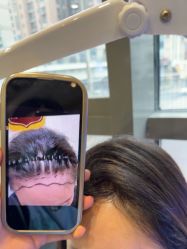 -碧莲盛·不剃发植发