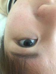 -美丽人生祛斑扁平疣汗管瘤中心