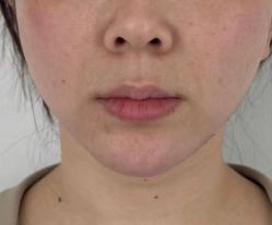 体验后-洁铭新加坡医美