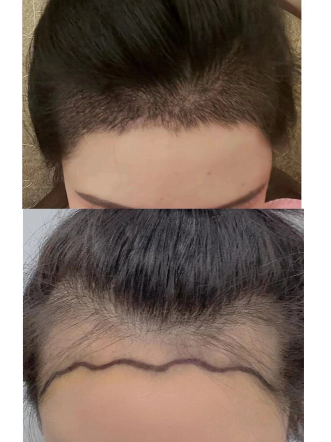植发际线一个多月的样子,前后有对比图哦