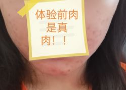 体验前-深圳美莱医疗美容医院