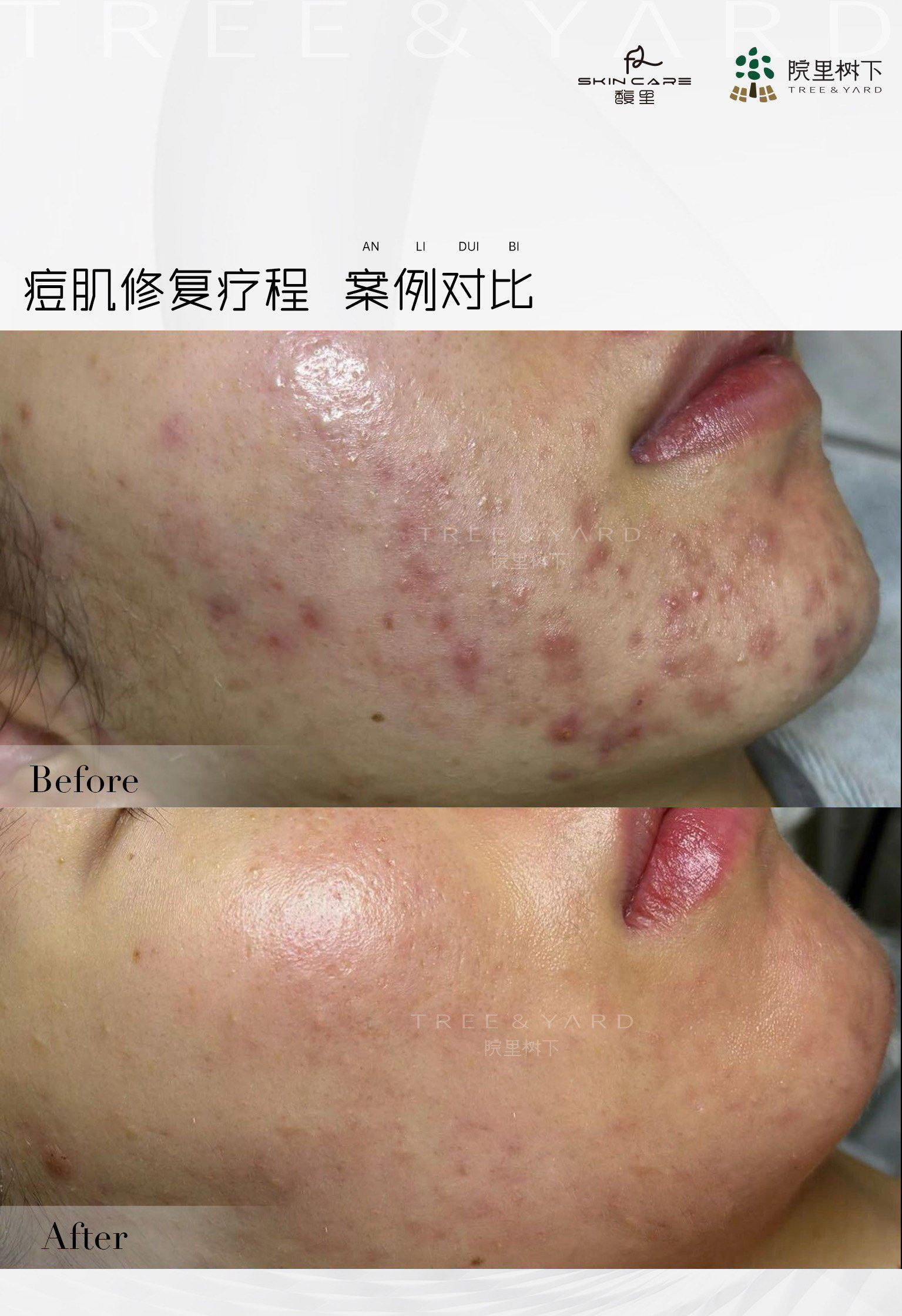 院里树下|痘肌刷酸案例

拒绝反