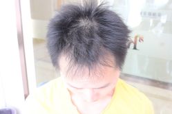 点击看大图 -大麦微针植发丨全国连锁