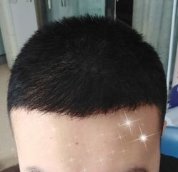 -大麦微针植发全国连锁