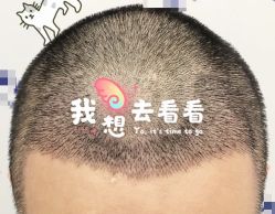 -大麦微针植发全国连锁