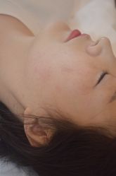 体验后-清疣美疣·痣·斑净肤中心