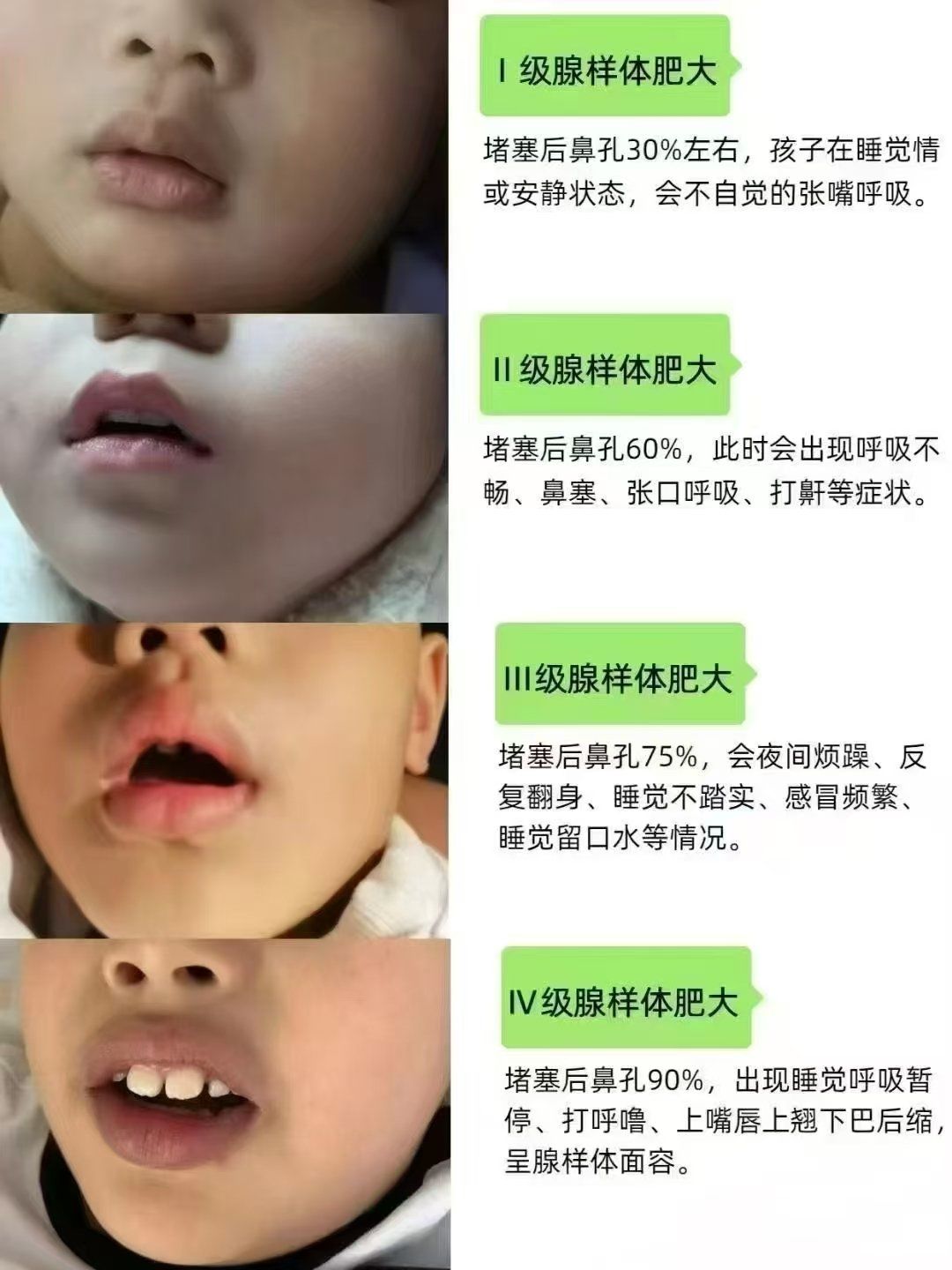 有腺样体肥大的孩子家长对照下吧!