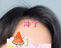 -大麦微针植发全国连锁