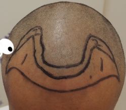 -大麦微针植发全国连锁