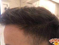 -大麦微针植发全国连锁
