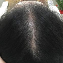 -大麦微针植发全国连锁