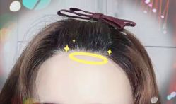 -大麦微针植发全国连锁