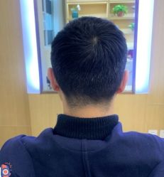 -大麦微针植发丨全国连锁