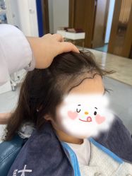 -大麦微针植发全国连锁