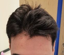 -大麦微针植发丨全国连锁