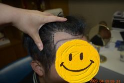 -大麦微针植发全国连锁