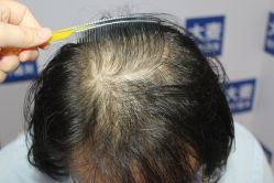 点击看大图 -大麦微针植发丨全国连锁