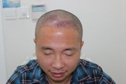 点击看大图 -大麦微针植发丨全国连锁