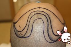 -大麦微针植发丨全国连锁