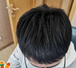 -大麦微针植发丨全国连锁