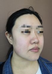 体验前-More摩尔医美の注射线雕光电中心