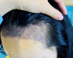 -大麦微针植发丨全国连锁