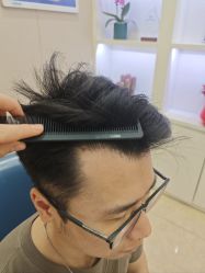 -大麦微针植发全国连锁