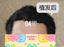 -大麦微针植发全国连锁