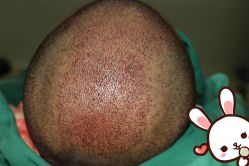 点击看大图 -大麦微针植发丨全国连锁