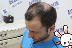 点击看大图 -大麦微针植发丨全国连锁