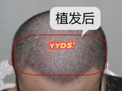 -大麦微针植发全国连锁