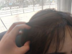 -碧莲盛·不剃发植发