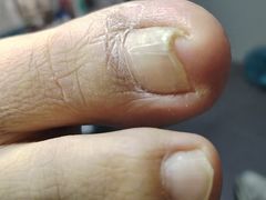 -祖传修脚甲沟炎灰指甲鸡眼