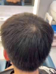 -大麦微针植发全国连锁