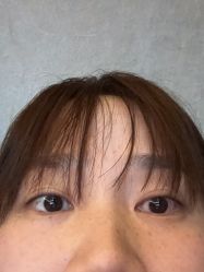 体验后-杭州海亮医院 · 禾芸嘉医美中心